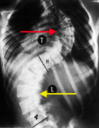 Scoliosis Scoliosis (6).gif